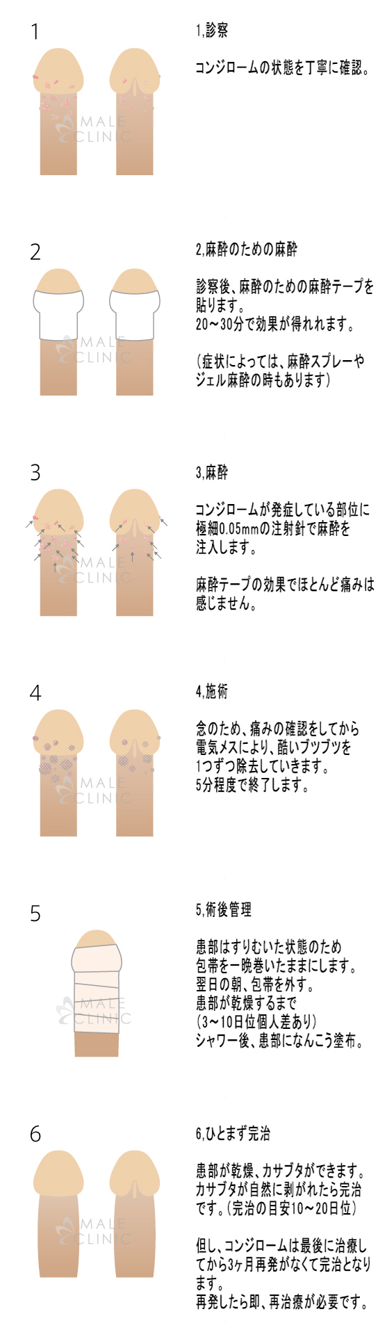 塗り薬 包皮 糖尿病 性 炎 亀頭包皮炎(陰茎・ペニス・ちんちんが痛い、痒い、赤い)