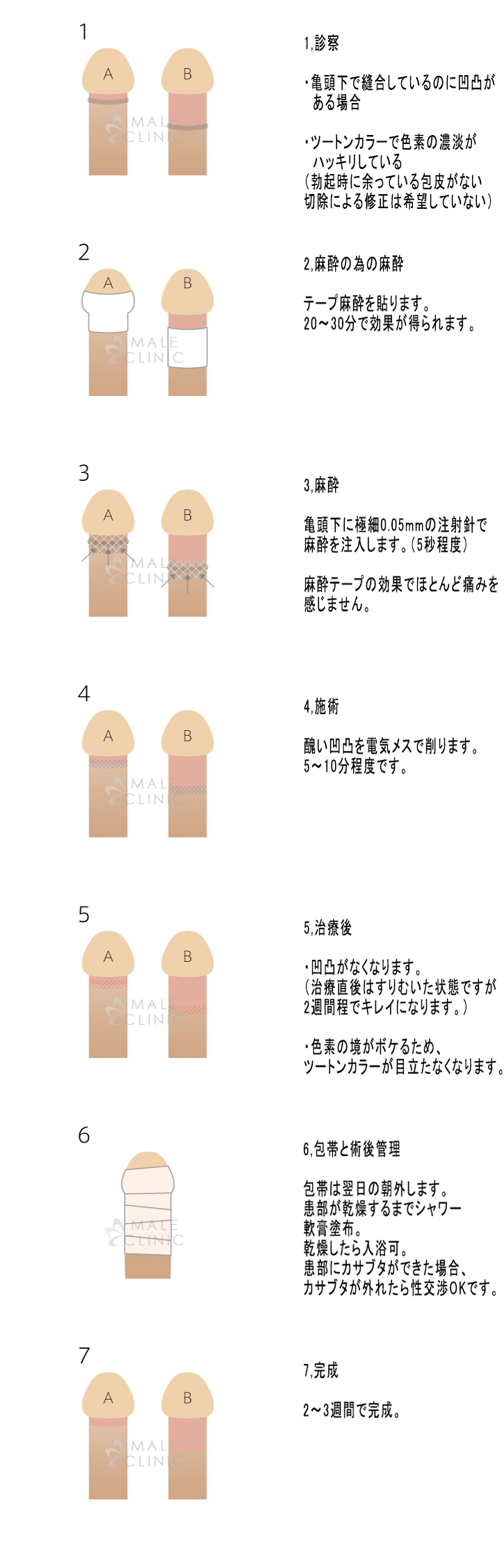 手術 カントン 包茎 カントン包茎・真性包茎